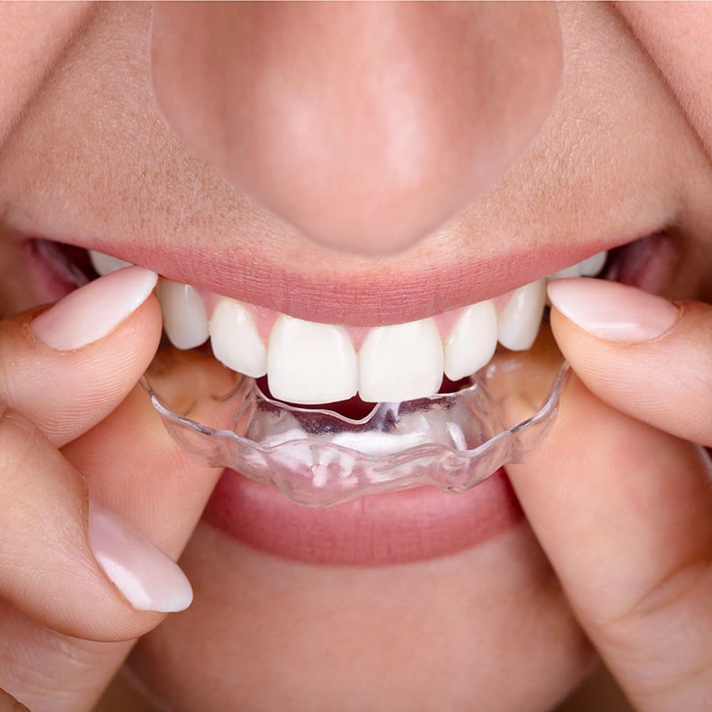 DENTAKRA Poprad - špecialista na neviditeľné zubné strojčeky Invisalign 